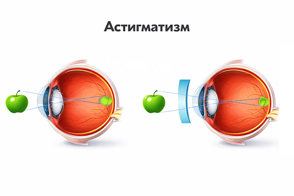 Симптомы миопического астигматизма